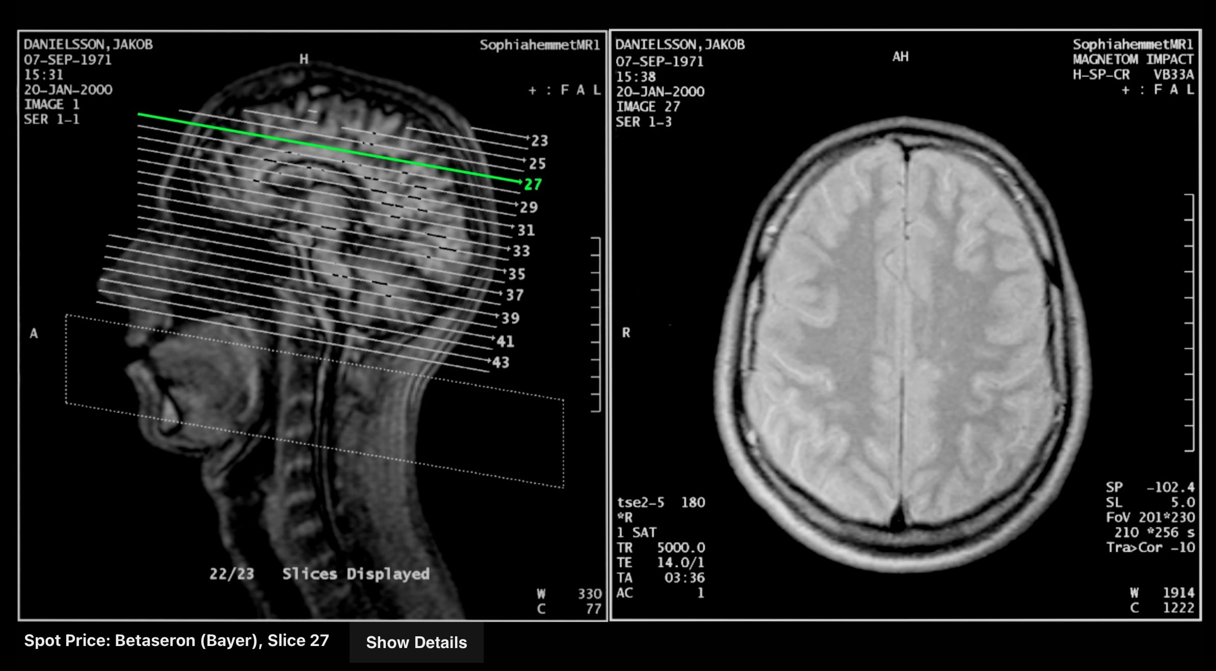 A digital image showing two views on an MRI brain scan
