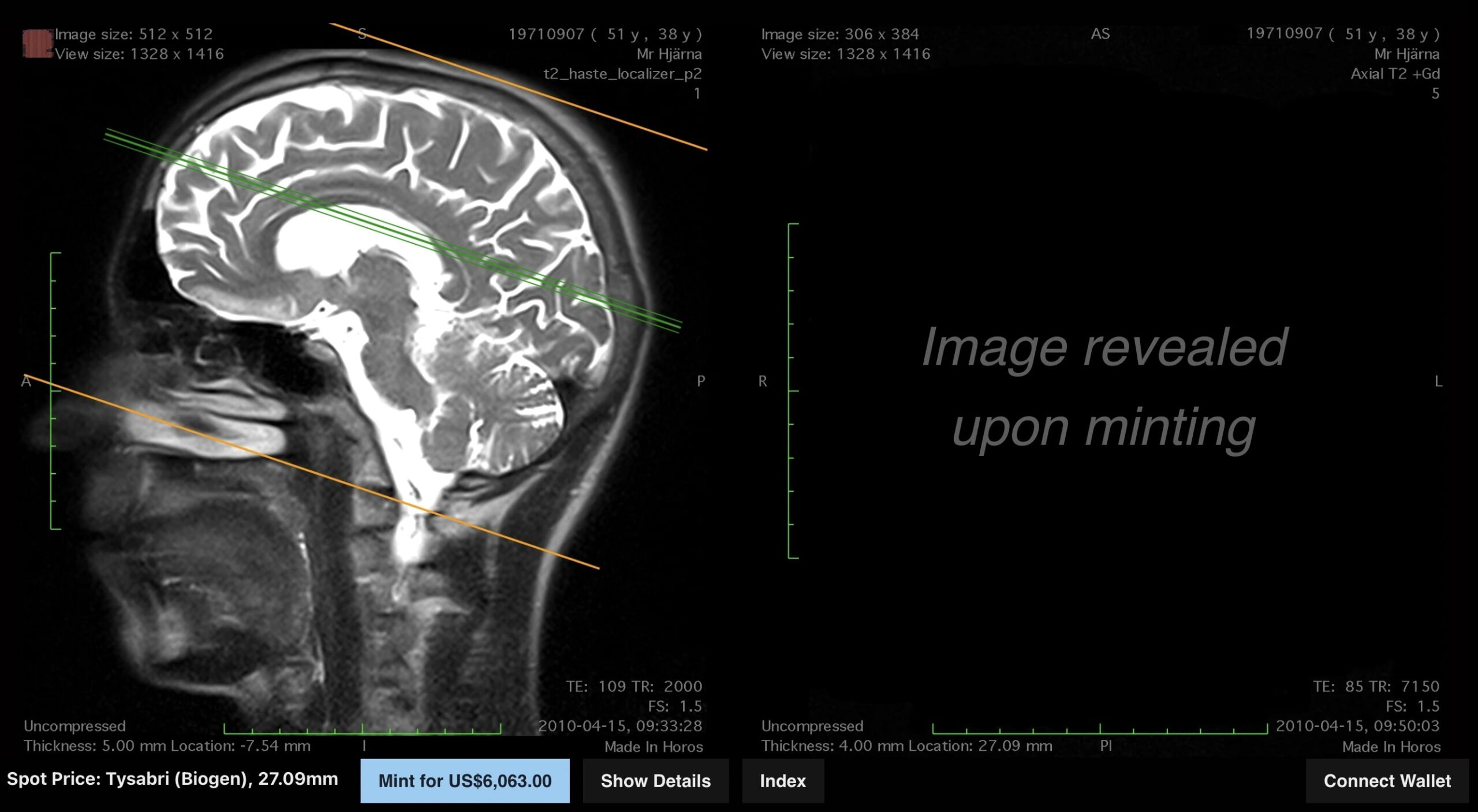 A digital image showing a side view of a brain MRI, and alongside it an empty space with the text 'image revealed upon minting'